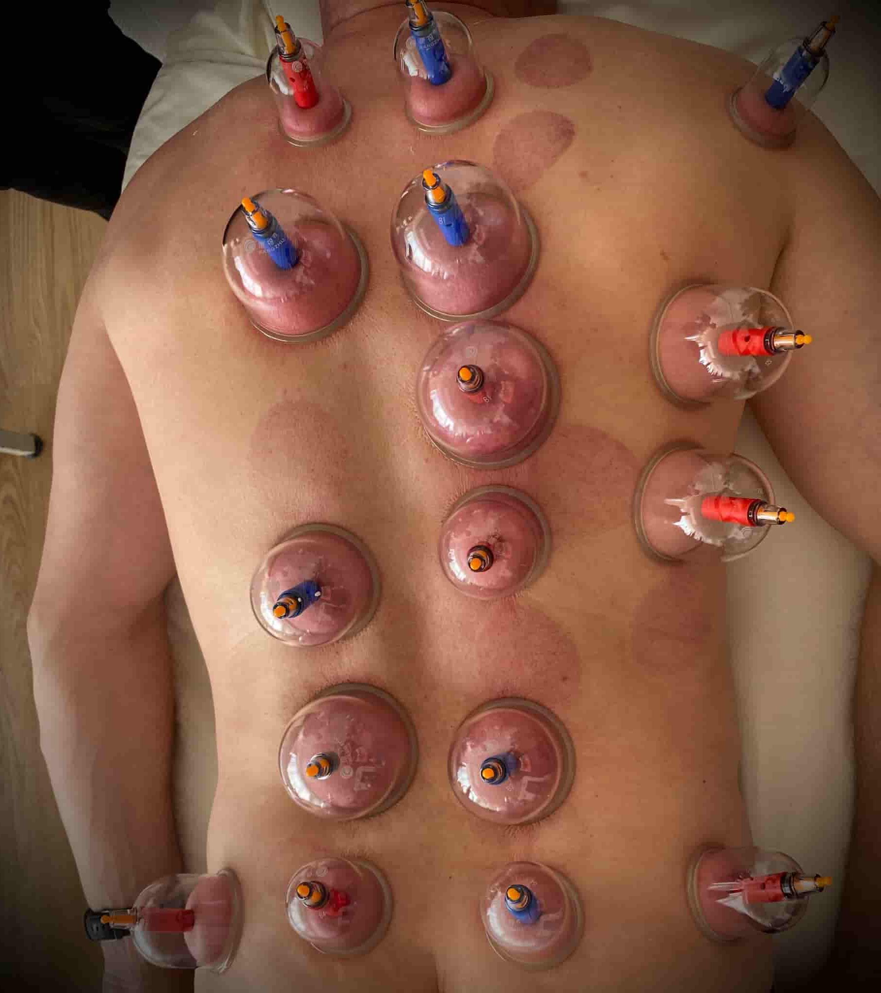 37B6F480-DCEC-476A-BCD9-CA538CEC160C-min Cupping på ryggen