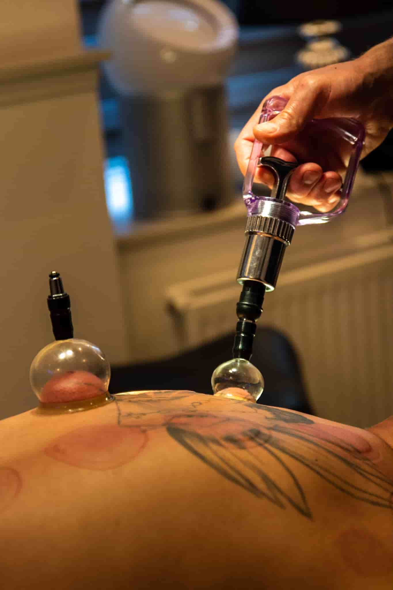612A3400-E2B5-4593-925A-6B074E15F842-min Løsning af spændinger med bindevævsmassage med cupping