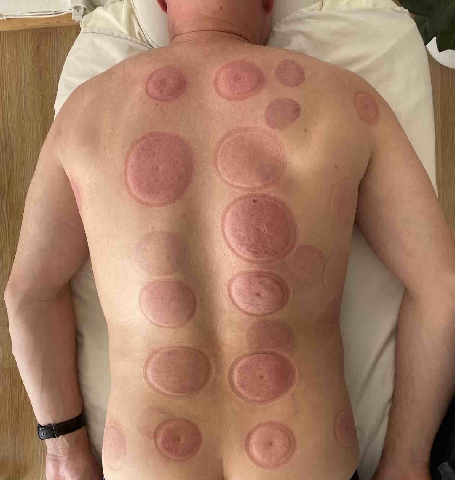 E60A8F17-C723-4F1A-8FFA-7D1FE0499127-min Mærker efter cupping